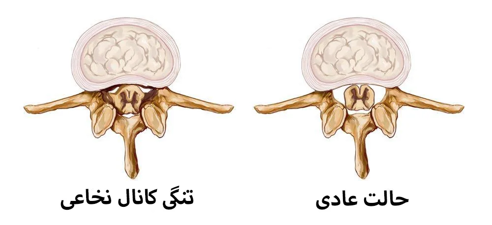 تشخیص تنگی کانال نخاعی