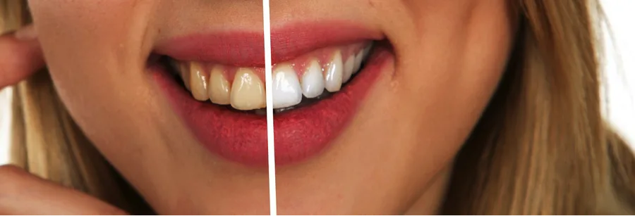 yellow-teeth-before-and-after.png